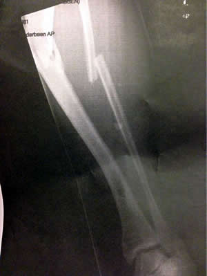 Leon Haslam's broken leg - picture from his wife Oli via  Twitter